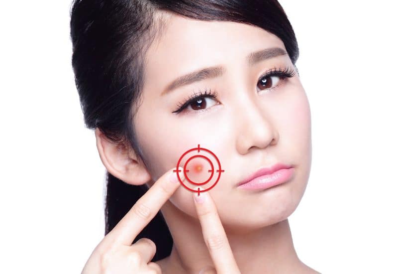 เปลี่ยนหน้าสิว เป็นหน้าใส ด้วยสมุนไพรจีน