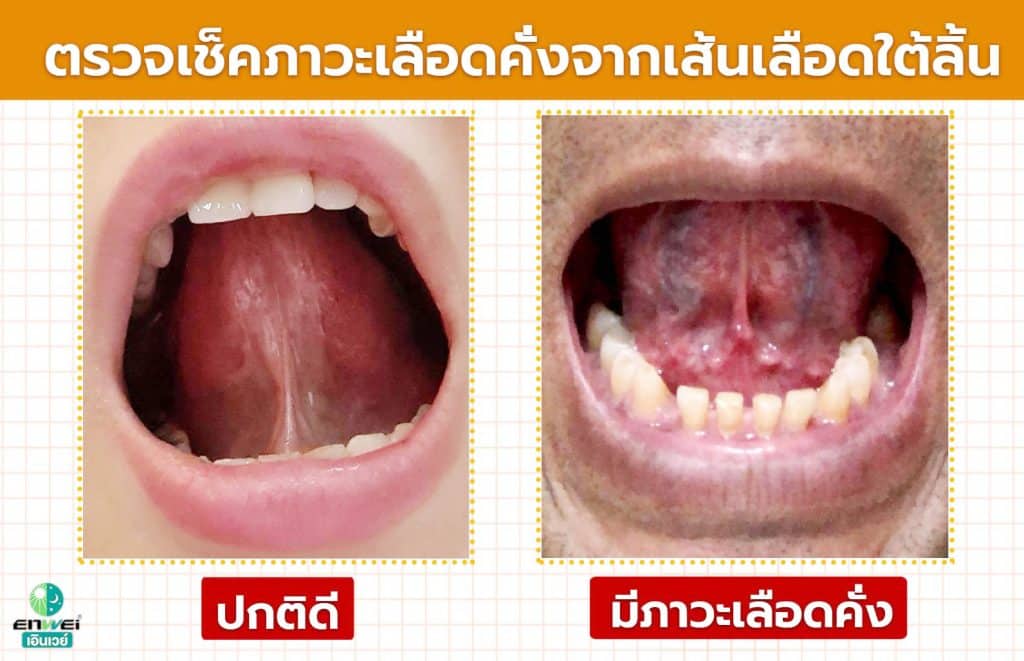 วิธีตรวจเช็คภาวะเลือดคั่งจากเส้นเลือดใต้ลิ้น