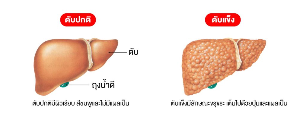 ภาพเปรียบเทียบตับแข็งและตับปกติ