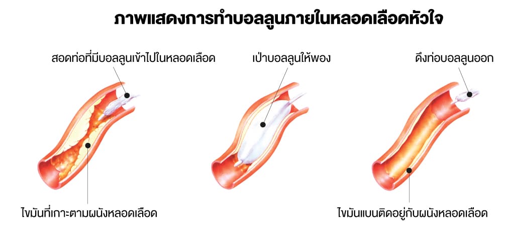 ภาพแสดงการทำบอลลูนภายในหลอดเลือดหัวใจ