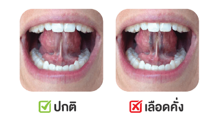 สังเกตภาวะเลือดคั่งด้วยตนเอง ให้ลองกระดกลิ้นขึ้น