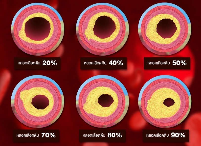 ภาพแสดงเส้นเลือดหัวใจตีบที่ระดับต่างๆ