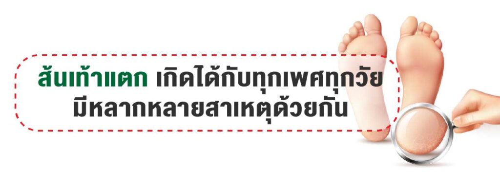ส้นเท้าแตก เกิดได้กับทุกเพศทุกวัย จากหลายสาเหตุ
