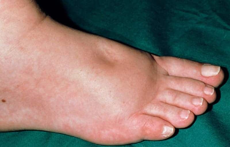 อาการบวมน้ำที่เท้า