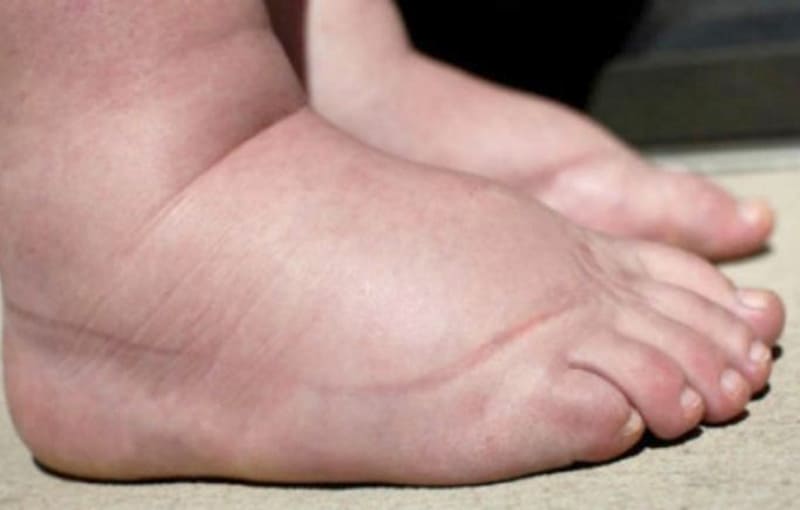 อาการบวมน้ำที่เท้า