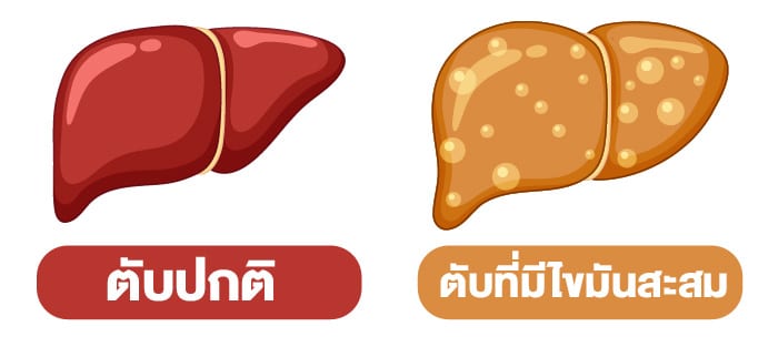 เปรียบเทียบตับปกติและตับที่มีไขมันสะสม