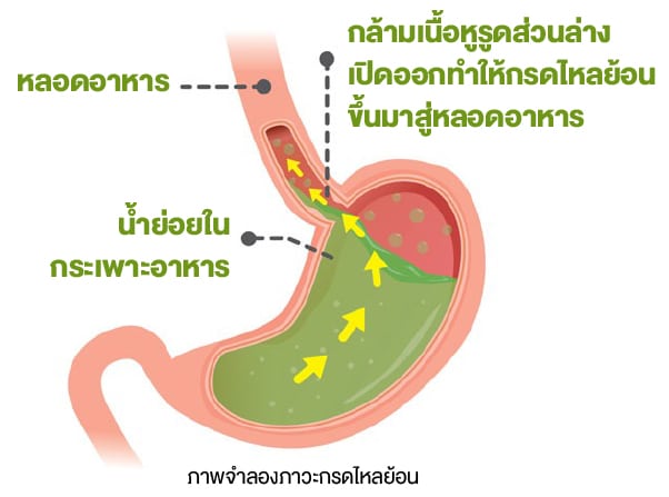 ภาพจำลองภาวะกรดไหลย้อน