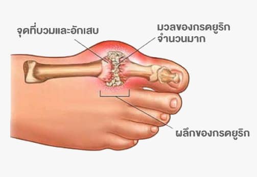 โรคเกาต์เกิดจากผลึกของกรดยูริกบริเวณข้อ