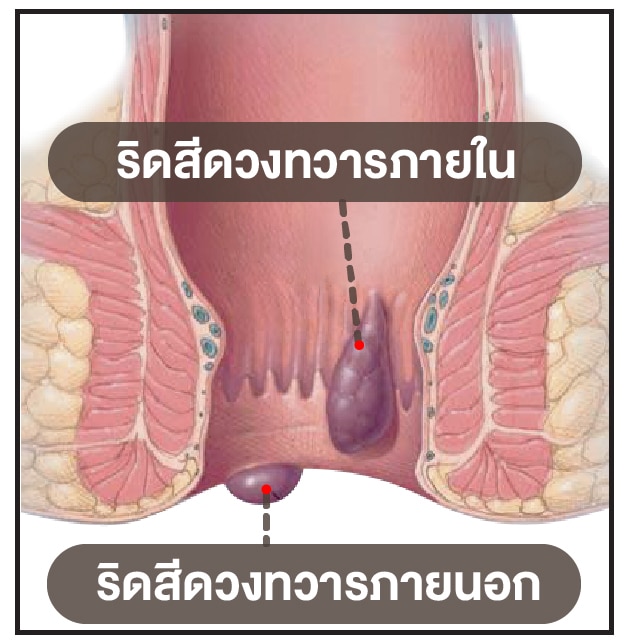 ริดสีดวงทวารมีชนิดใดบ้าง