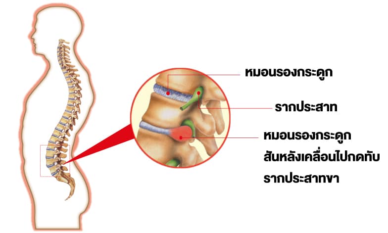 หมอนรองกระดูกสันหลังทับเส้นประสาท ทำให้เกิดอาการปวดร้าวลงขา