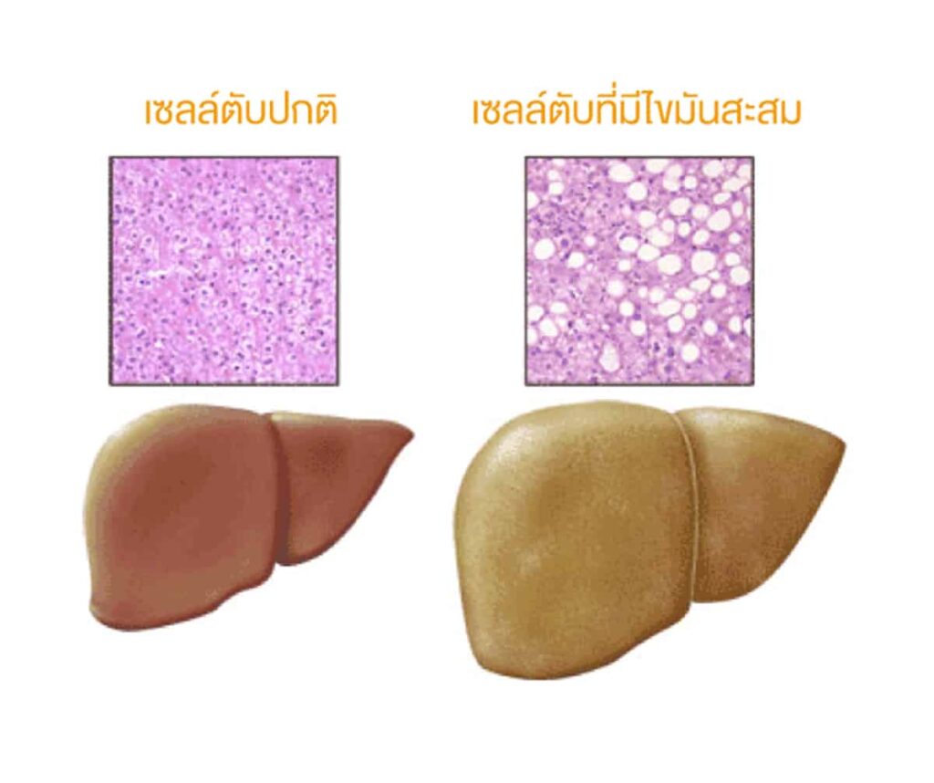 เปรียบเทียบเซลล์ตับปกติและเซลล์ตับที่มีไขมันสะสม
