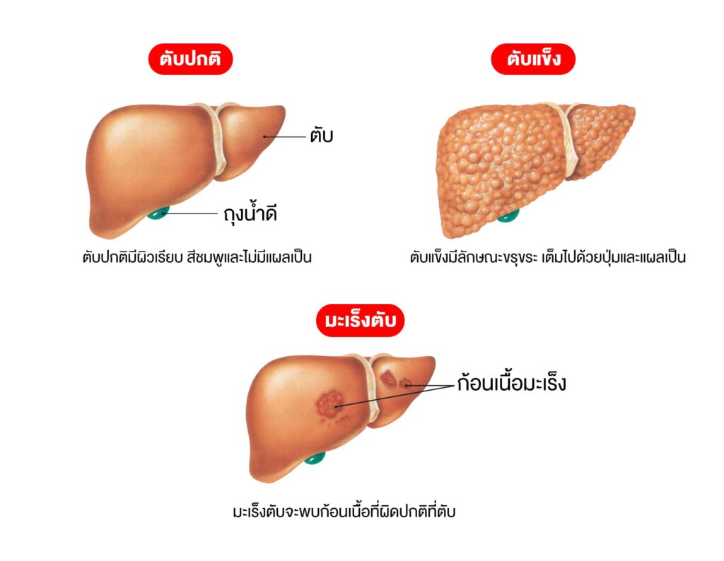ภาพเปรียบเทียบตับปกติ ตับแข็ง และตับที่เป็นมะเร็ง