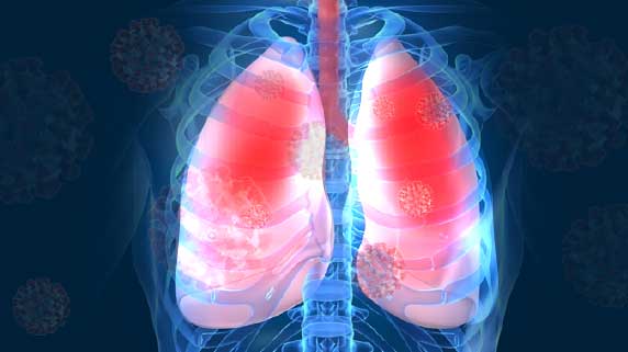 ผู้ติดเชื้อโควิด ระบบทางเดินหายใจจะเกิดการอักเสบจนอาจเกิดพังผืดขึ้นในปอด