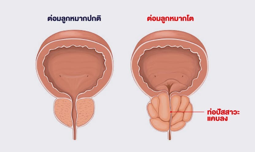 ต่อมลูกหมากโตคืออะไร