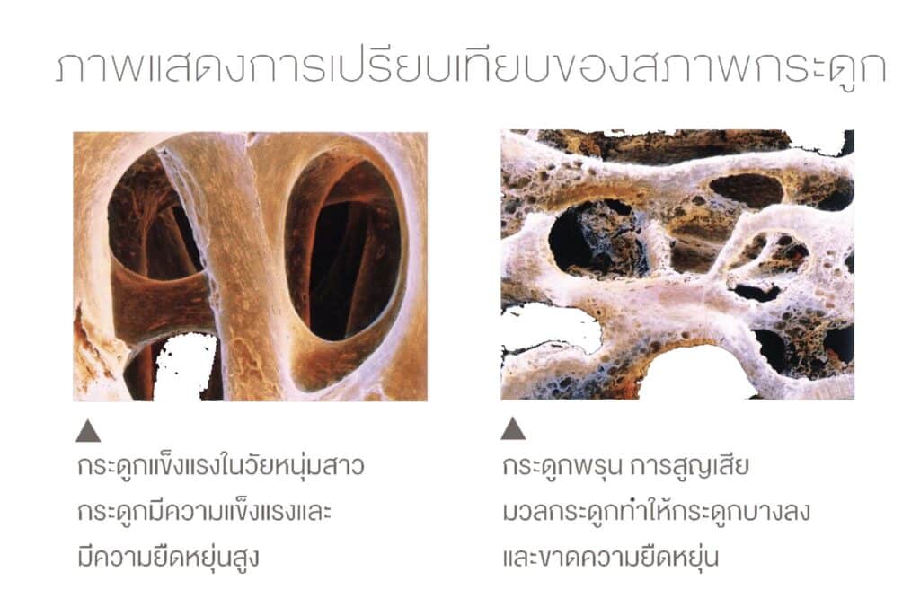 ภาพเปรียบเทียบภาวะกระดูกพรุนและกระดูกปกติ