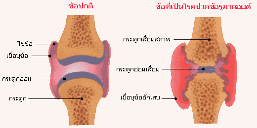 โรคปวดข้อรูมาตอยด์เกิดจากสาเหตุอะไร