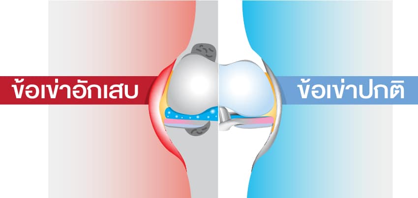 ภาพเปรียบเทียบข้อเข่าปกติและข้อเข่าที่อักเสบ