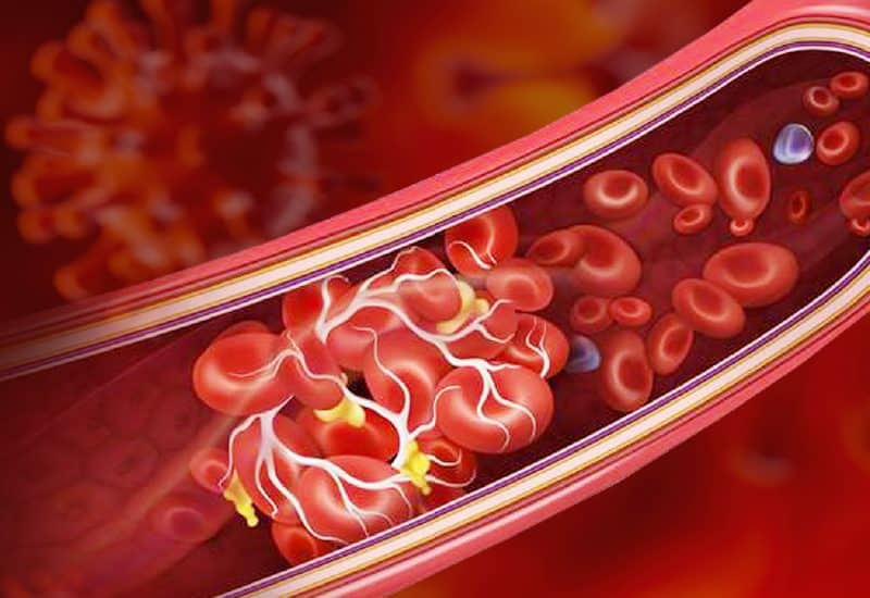ติดโควิด เสี่ยงลิ่มเลือดอุดตันสูง ดูแลหลอดเลือดทันทีหลังหายป่วย