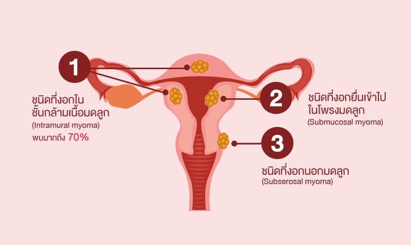 ชนิดของเนื้องอกมดลูก