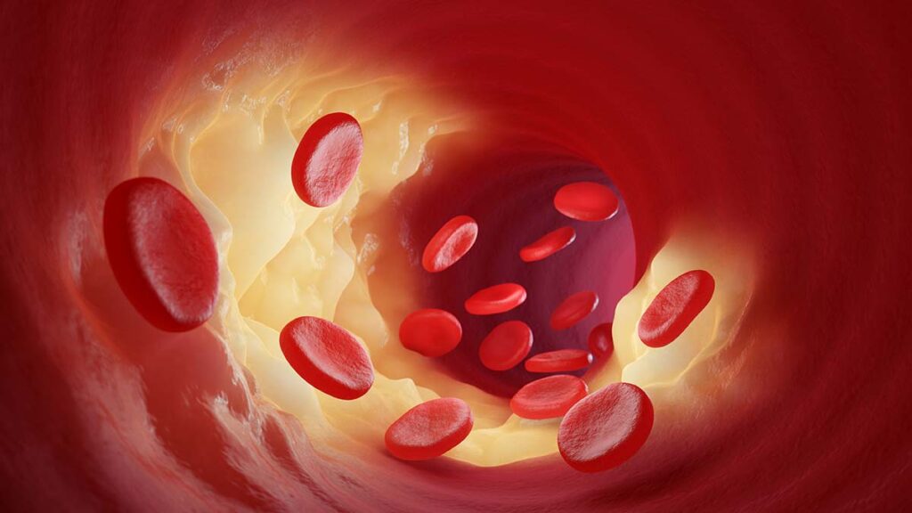 ไขมันในเลือดสูงเกิดจากอะไร รักษาหายไหม แล้วมีอาการแสดงอะไรบ้าง