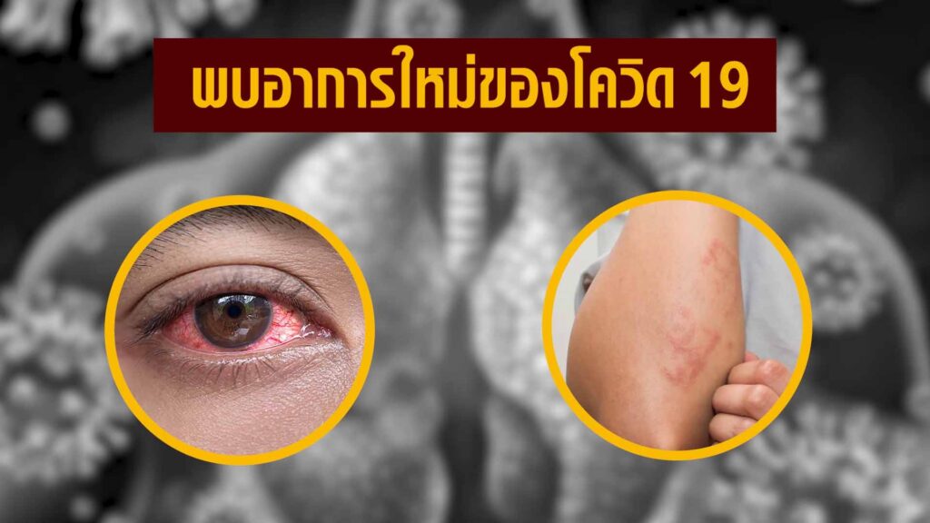 พบอาการใหม่โควิด-19 ทีมแพทย์จีนเหลียนฮัว ฮั่วเซียง เอินเวย์ Enwei แนะแนวทางป้องกันรักษา พบอาการใหม่โควิด-19 ทีมแพทย์จีนเหลียนฮัว ฮั่วเซียง เอินเวย์ Enwei แนะแนวทางป้องกันรักษา