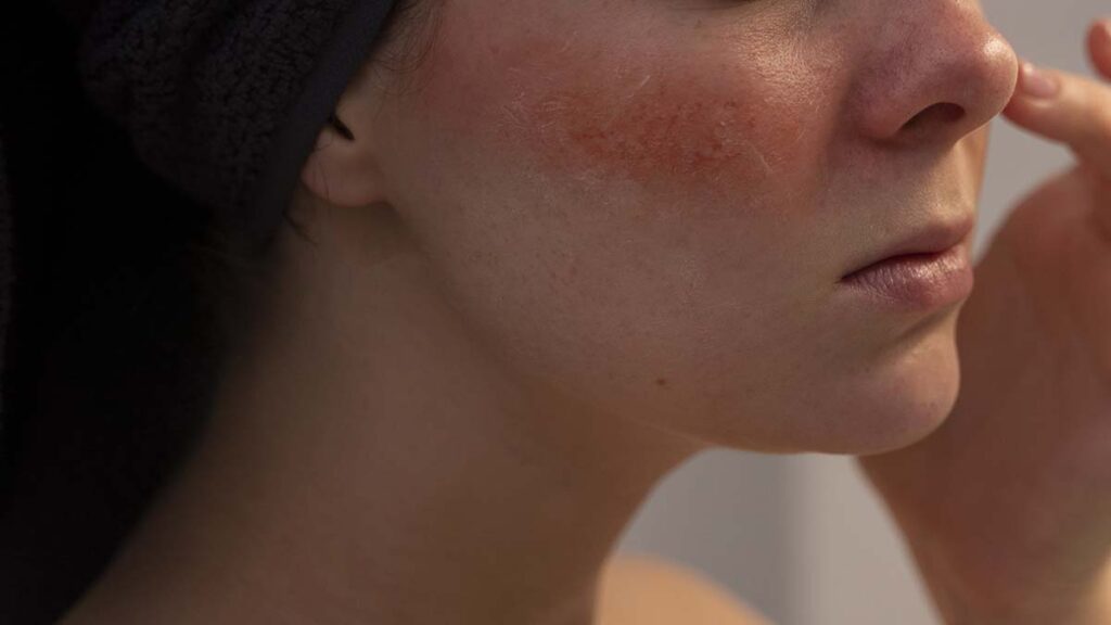 โรคแพ้ภูมิตัวเอง (SLE) สาเหตุ อาการ และวิธีบำบัดในทางแพทย์จีน