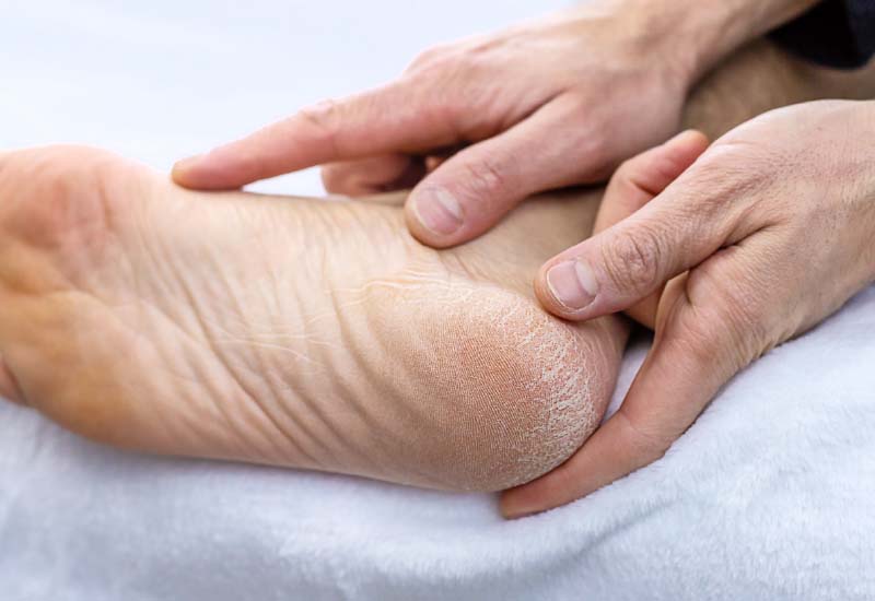 ส้นเท้าแตก ผิวแห้ง ผิวหยาบ กวนใจคุณใช่ไหม ศาสตร์แพทย์จีนช่วยได้