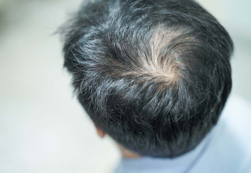 ผมร่วง ผมบาง ผมร่วงเป็นหย่อมๆ งอกใหม่ได้ ด้วยการแพทย์จีน