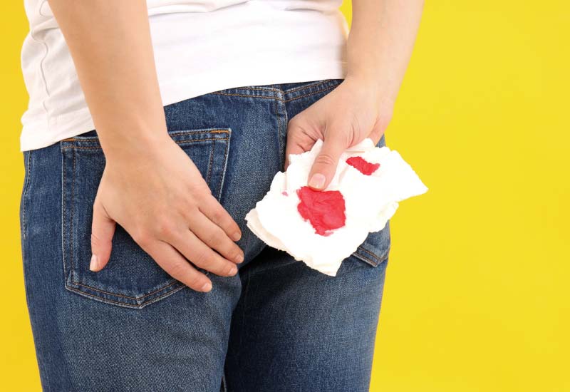 ทำอย่างไร เมื่อคุณเป็นริดสีดวงทวารหนัก