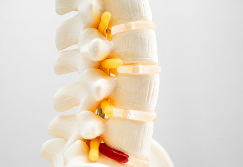 กระดูกทับเส้นไม่ต้องผ่าตัด ไม่ง้อยาแก้ปวด แก้ด้วยยาสมุนไพรจีน