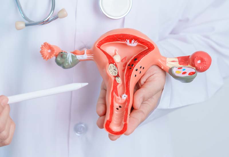 เนื้องอกมดลูก การแพทย์จีนช่วยบำบัดและรักษาที่ต้นเหตุ