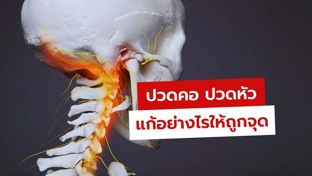 ปวดคอ ปวดหัว อะไรเกิดก่อนกัน แก้อย่างไรให้ถูกจุด
