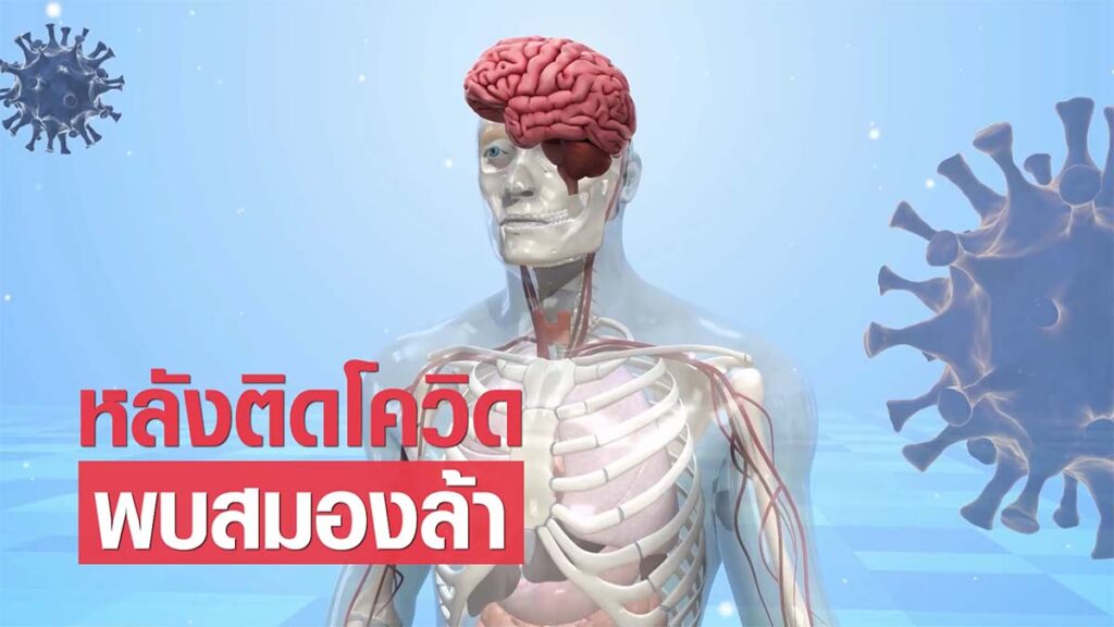 พบสมองล้าบ่อย หลังติดโควิด แถมด้วยสมองเสื่อมและลมบ้าหมู