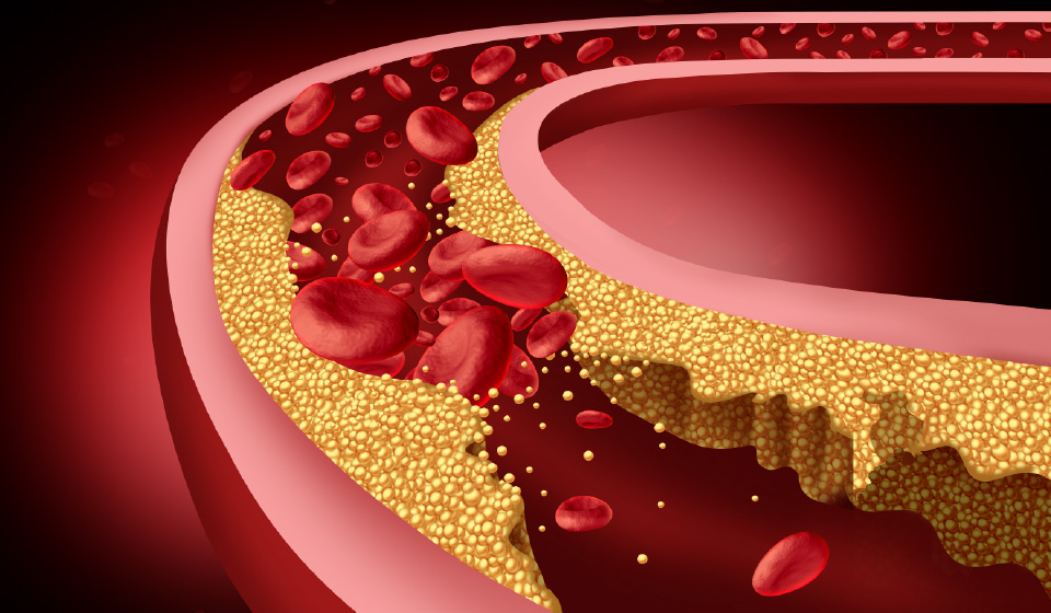ซีรีส์บทความ : ดูแลคราบไขมันและหินปูนในหลอดเลือดด้วยสมุนไพรจีน