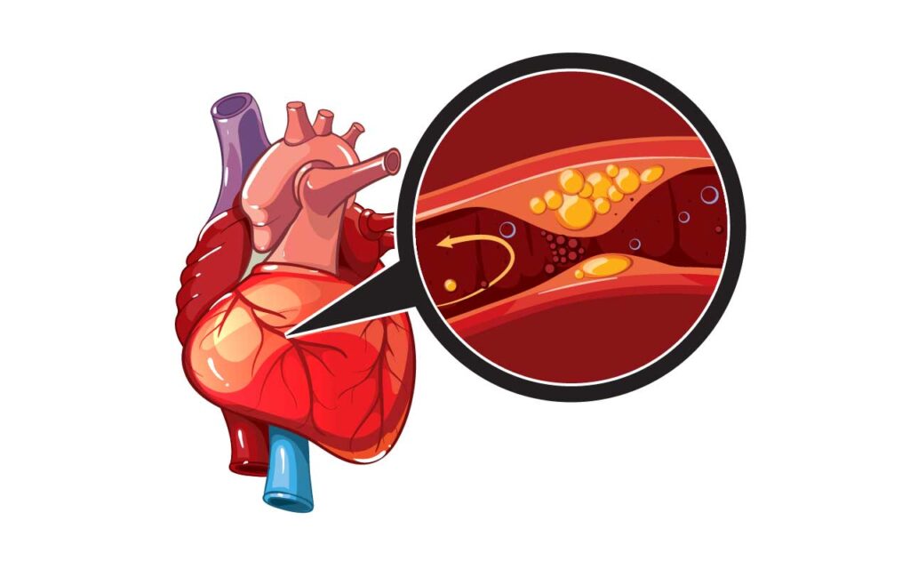 รักษาหลอดเลือดหัวใจตีบที่ต้นเหตุ ด้วยนวัตกรรมสมุนไพรจีน