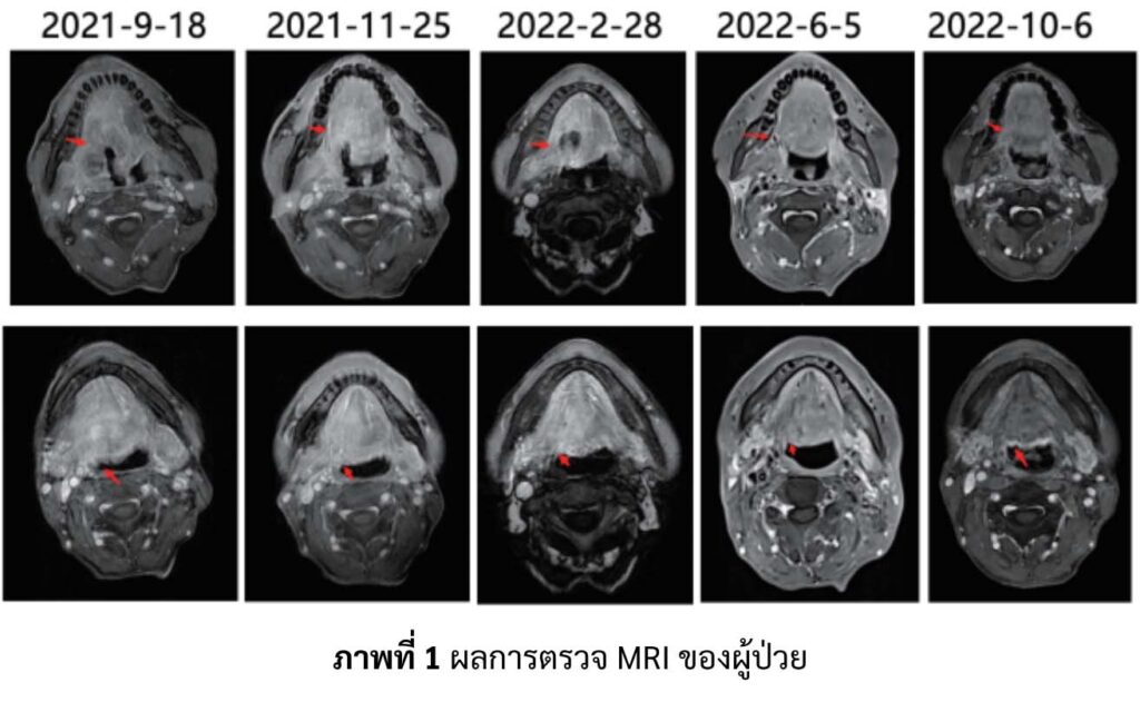 มะเร็งลิ้น เคส A ผลตรวจ MRI